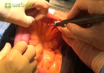 Bilden der Roux-Y Schlinge