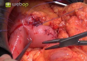 Gastrojejunostomie – Vorderwandnaht