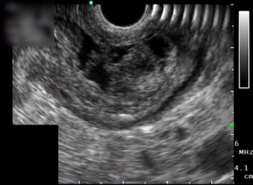 Explorative Laparoskopie