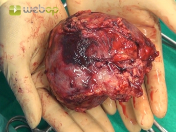 Entnahme des Präparates