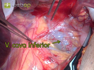 Darstellung des rechten Retroperitoneums mit Verlagerung der Leber nach kranial und medial