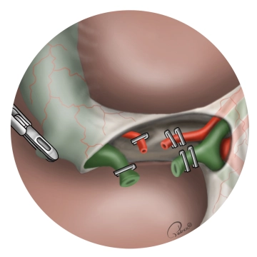 Clippen des Ductus cysticus und Durchtrennung