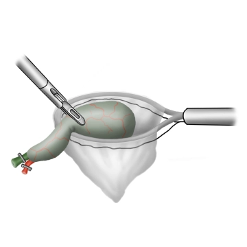 Extraktion der Gallenblase