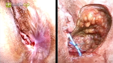 Einlegen eines Silikon-Fadens