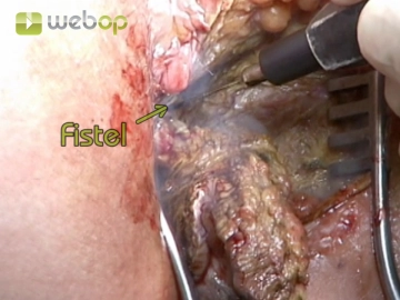 Exzision der extrasphinktären Fistelanteile