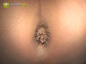 Definition; Pathophysiologie