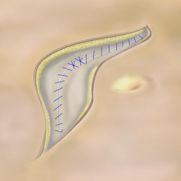Fortlaufender Faszienverschluss mit der Schlinge; Verknotung