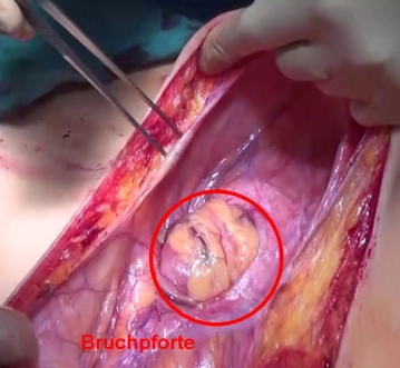 Hautschnitt und Eröffnung des Bruchsacks