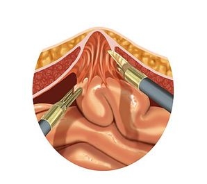 Adhäsiolyse mit Darstellung der Bruchpforte