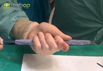 Einbringen des Netzes