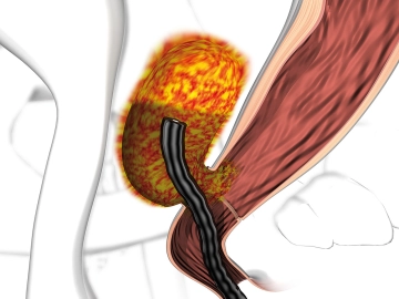 Flexibel-endoskopische Untersuchung mit Ausmessen der Wundhöhle