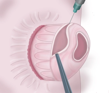 Trennen der Rektum-Mukosa von der Muskelschicht