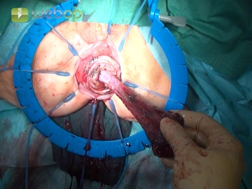 Zylindrische Abpräparation der Rektumschleimhaut