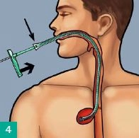 Einführen des Schwammes