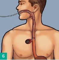 Endoskopische Vakuumtherapie bei Perforationen und Anastomoseninsuffizienzen am oberen GI-Trakt 1