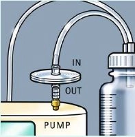 Endoskopische Vakuumtherapie bei Perforationen und Anastomoseninsuffizienzen am oberen GI-Trakt 2