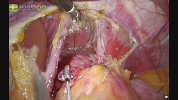 Transmurale Verankerung der 1.Elektrode
