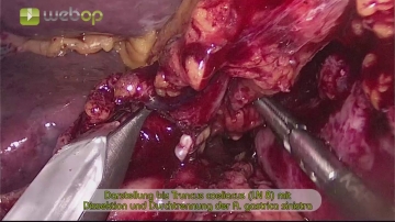 Darstellung des Truncus coeliacus (LN 8) mit Dissektion und Durchtrennung der A. gastrica sinistra