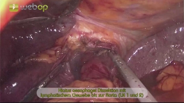 Dissektion des Hiatus oesophagei inkl. Lymphadenektomie bis zur Aorta (LN 1 u. 2)