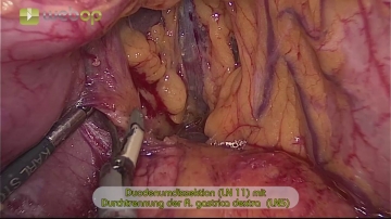 Dissektion des Duodenums (LN 11) und Durchtrennung der A. gastrica dextra