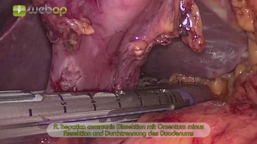 Dissektion der A. hepatica communis, Resektion des Omentum minus und Absetzen des Duodenums