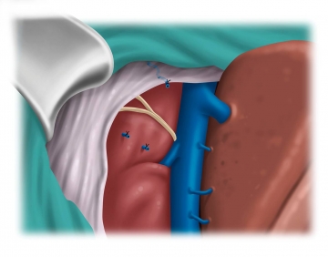 Präparation der Vena cava