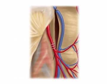 Durchtrennung der Arteria mesenterica inferior