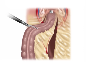 Präparation des proximalen Rektums