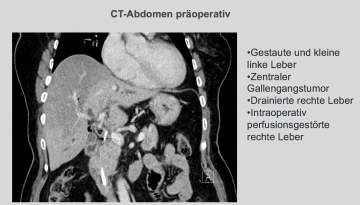 Perioperatives Management Zentrale Leberresektion Mesohepatektomie