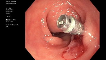 Exploration; intraoperative Endoskopie 