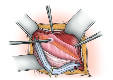 Spaltung der Fascia transversalis