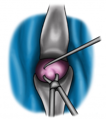 Einbringen der Uterussonde und Anteflexion des Uterus