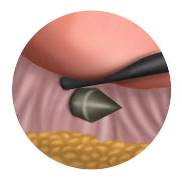 Einbringen der vaginalen Instrumente