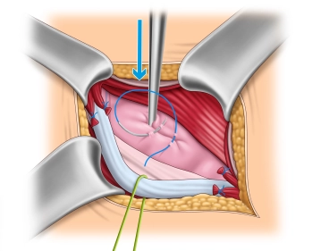 Bruchsackversorgung – Direkte Hernie