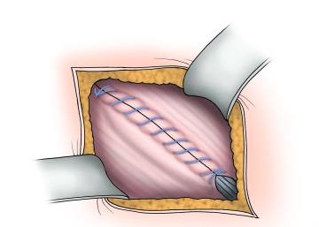 Verschluss der Externus-Aponeurose