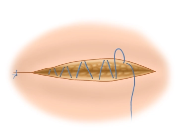 Beenden der Operation