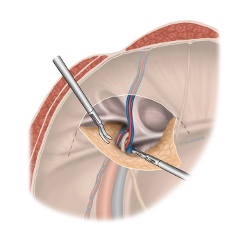 Freilegung und Reposition des Bruchsacks, Netzlagerpräparation