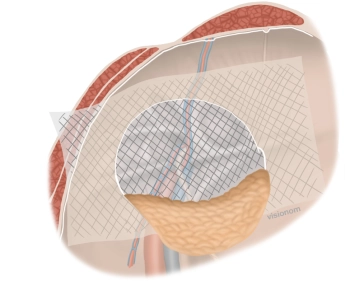 Einbringen des Netzes