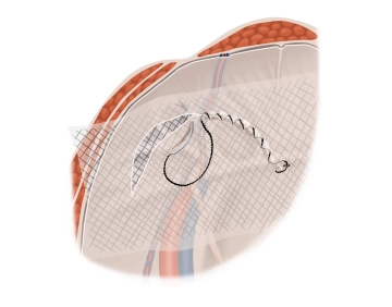 Verschluss der Peritonealinzision