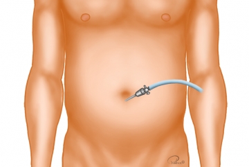 Anlage Pneumoperitoneum