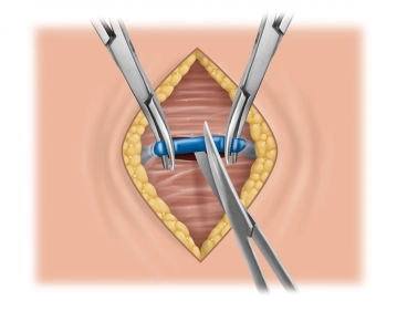 Subkutane Präparation, Durchtrennung der Mittellinie