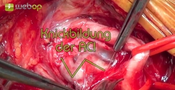 Präparation der A. carotis interna et externa