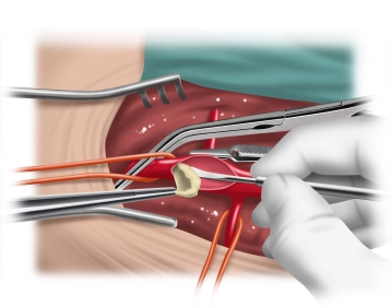 TEA der A. femoralis rechts