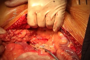 Eröffnung des Retroperitoneums und Präparation der Aorta