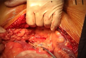 Eröffnung des Retroperitoneums und Präparation der Aorta