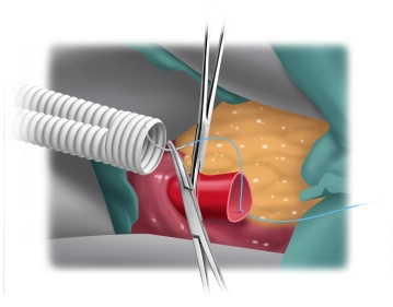 Zentrale End-zu-End-Anastomose