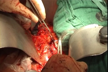 Verschluss des Retroperitoneums