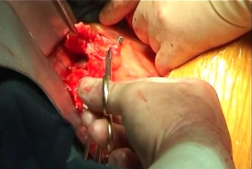 Präparation der infrarenalen Aorta