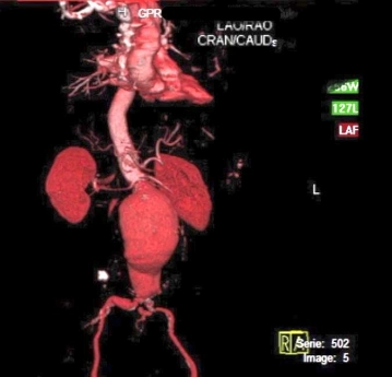 Dynamische, dreidimensionale Spiral-CT-Darstellung des infrarenalen abdominalen Aortenaneurysmas (AAA)