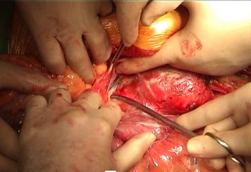 Präparation der Beckenarterien und des Aneurysma-Halses